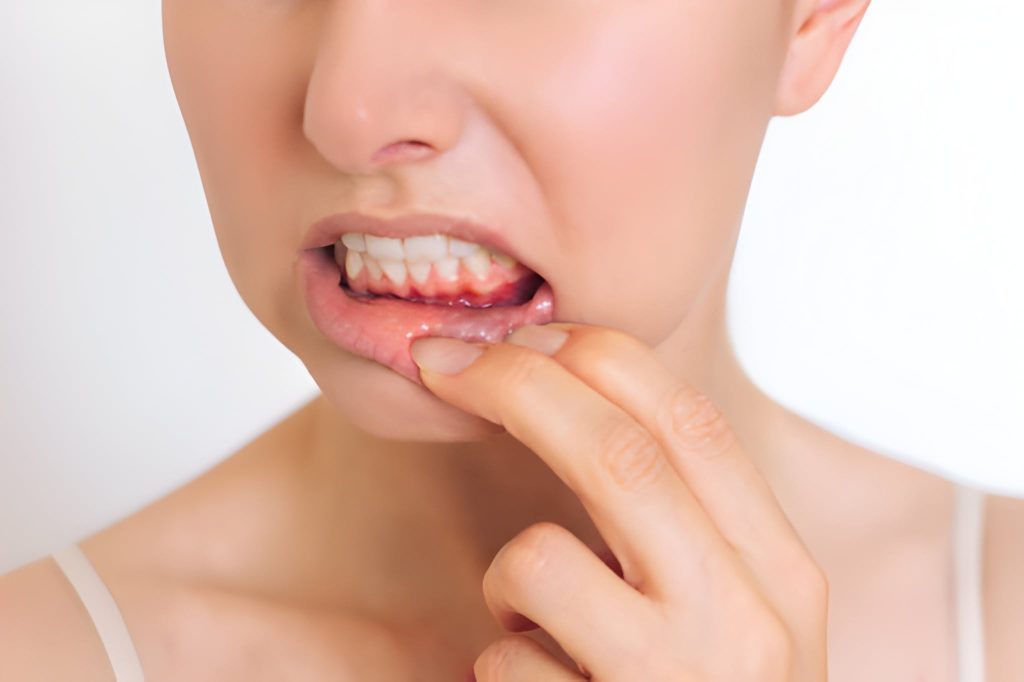 Gum Disease