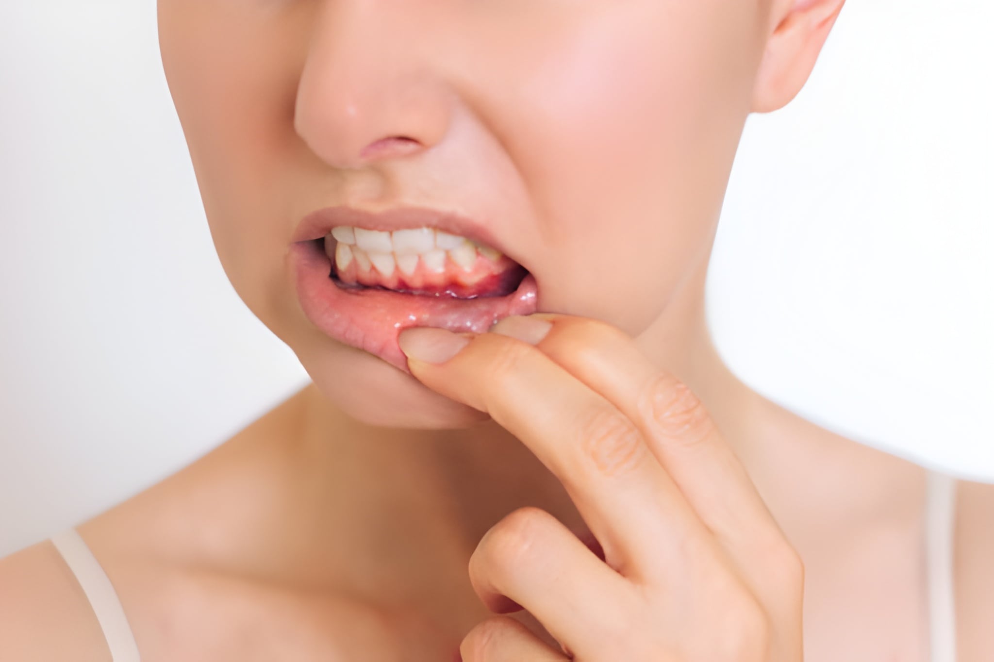 Gum Disease