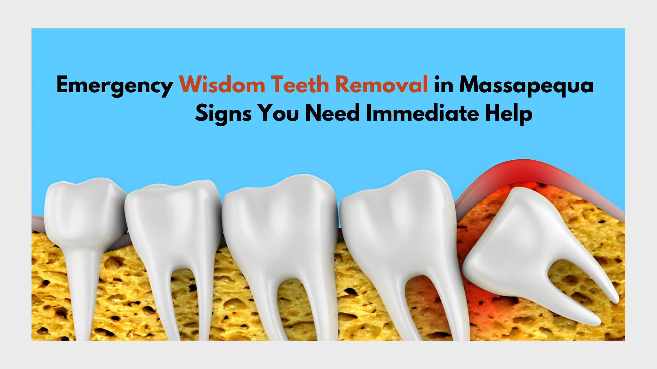 Wisdom Teeth Removal